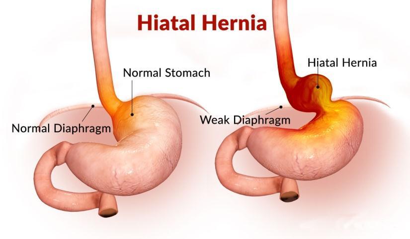 Hiatal-Hernia-It-can-be-diagnosed-if-the-following-symptoms-are-found-heartburn-chest